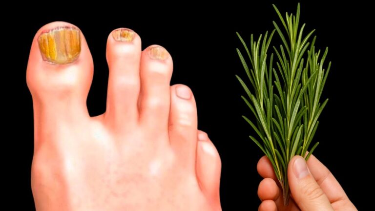 Non ci crederai… il fungo sparito in un giorno con un trucco segreto!