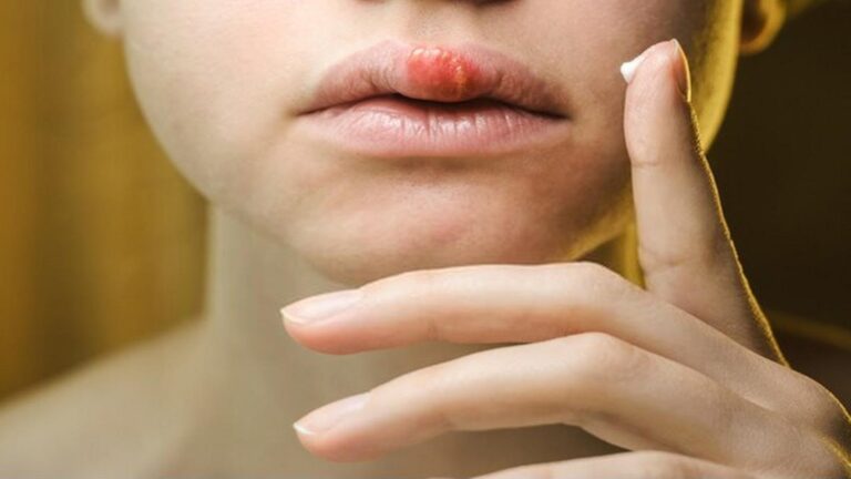 Questo semplice gesto riduce l’herpes labiale come un farmaco… scopri i migliori rimedi!