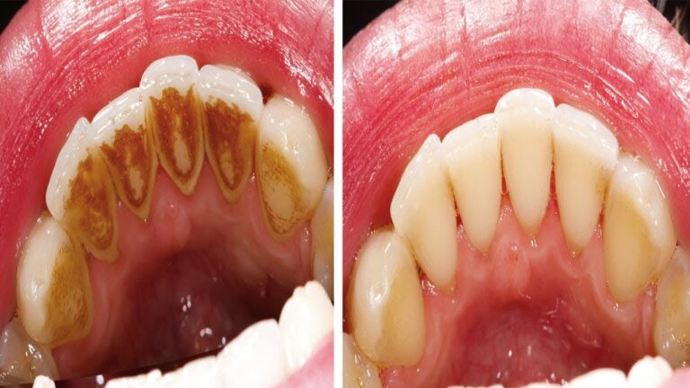 5 metodi semplici per rimuovere il tartaro e avere un sorriso brillante