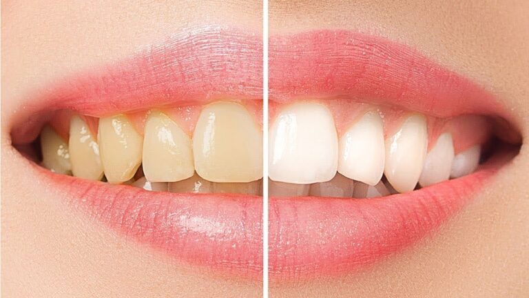 5 metodi naturali per sbiancare i denti e avere un sorriso brillante!