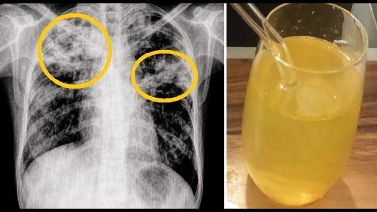 5 Rimedi Efficaci Per Eliminare Catarro E Muco Da Petto E Gola Subito!