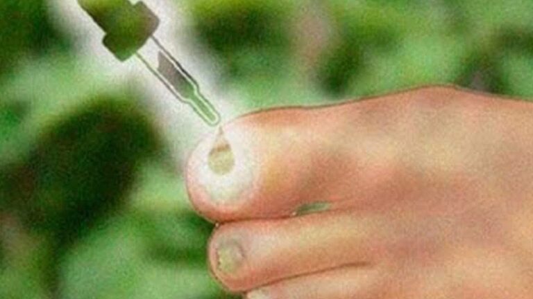 Elimina il piede d’atleta in 5 semplici passi! Scopri come farlo ora!