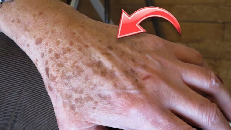 Riduci i tuoi 5 segreti per attenuare le macchie della pelle in modo naturale!
