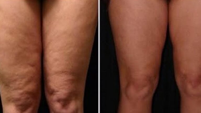 Scopri 5 rimedi sorprendenti per la cura delle gambe che tutti ignorano!